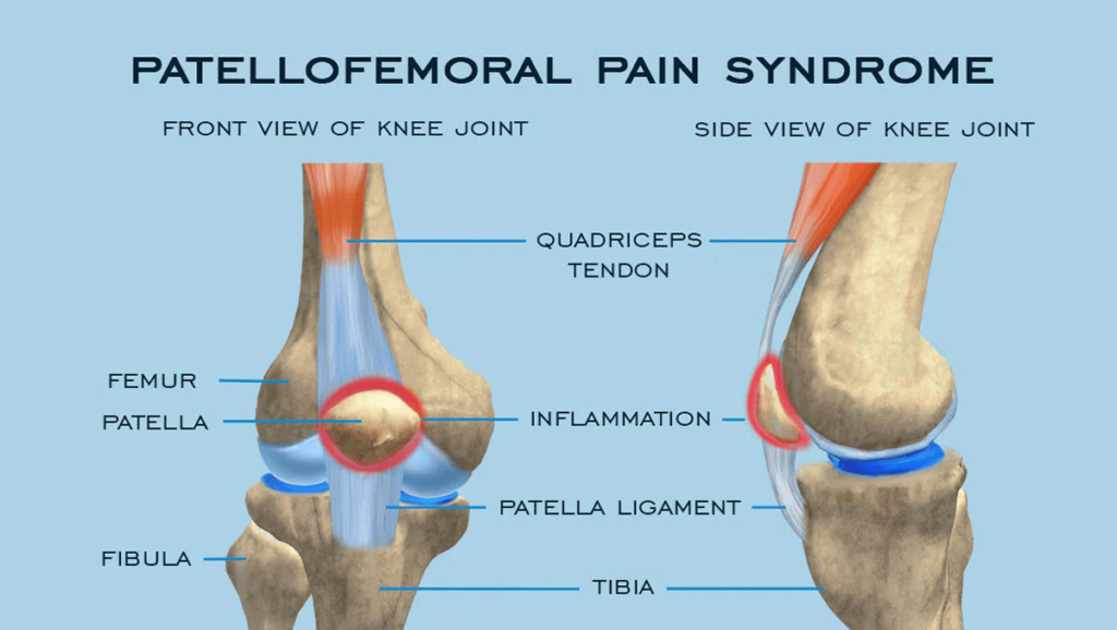 Runner’s Knee (Patellofemoral Pain Syndrome): Causes, Symptoms, and ...